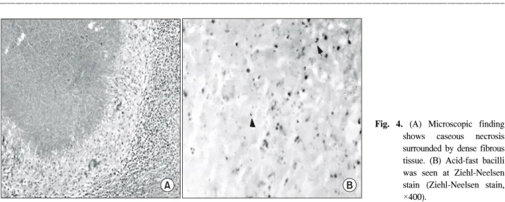 Fig.  4.  (A)  Microscopic  finding  shows  caseous  necrosis  surrounded  by  dense  fibrous  tissue