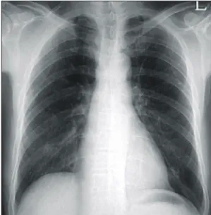 Fig.  1.  Chest  X-ray  (PA)  Chest  radiograph  shows  old  tuberculosis  in  left  upper  lung  zone.