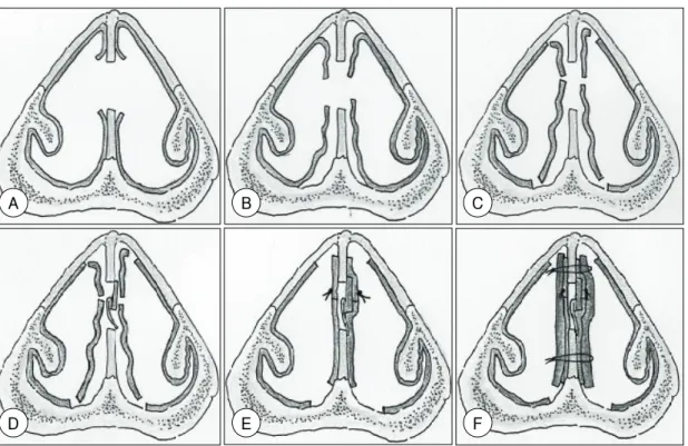 Fig. 6. Illustration of devised a grafting with auricular cartilage designed as bilobed structure in this study；coronal view.