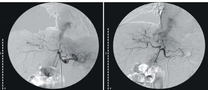 Fig.  3.  A  five  by  four  cm  sized  tumor  thrombus  showed  in  the  right  atrium