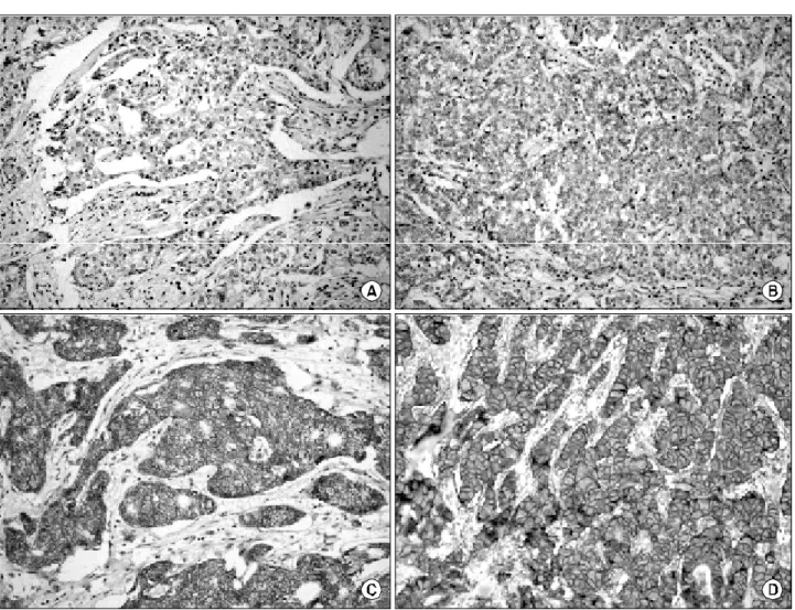 Fig.  1.  HER-2  immunohistochemical  staining  by  HercepTest R . (A)  0,  (B)  1+,  (C)  2+,  (D)  3+  (original  magnification  ×200).