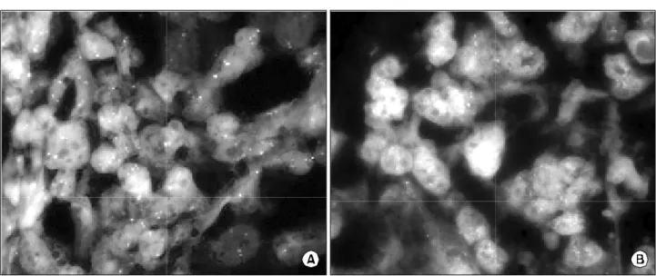 Fig.  2.  Fluorescence  in  situ  hybridization  for  HER-2  amplification  in  breast  cancer