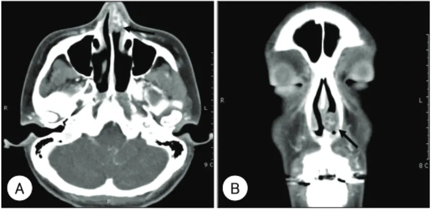 Fig.  1 .  Preoperative axial (A) and  coronal (B) computerized  tomog-raphic  (CT) scan of paranasal  si-nus