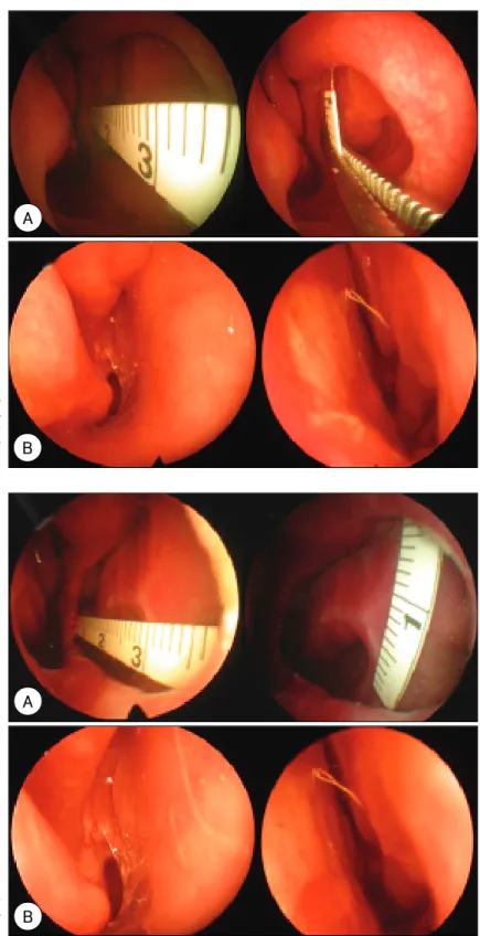 Fig. 1. Preoperative view of 21-year- 21-year-old female patient  presenting with a 3.4×1.5 cm sized septal  perforat-ion (A)