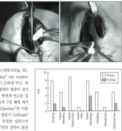 Fig. 5. Comparison of the mean preoperative (Preop.) subjective VAS scores and postoperative (Postop.)  sub-jective VAS scores in large septal perforation