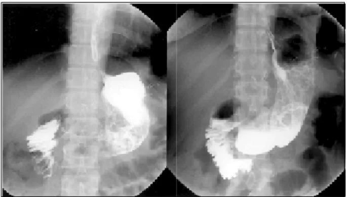 Fig.  4.  A  fluoroscopic  contrast  study  performed  on  postoperative  day  4th  did  not  reveal  any  leakage  nor  stricture  formation  at  the  anastomotic  site