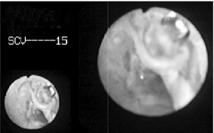 Fig.  1.  Initial  abdominal  radiograph  showing  three  groups  of  me- me-tallic  surgical  clips  (arrows)