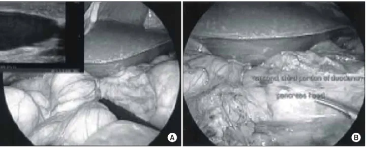Fig.  2.  Trocars  site  and  positioning.  A  square:  10  mm  trocar,  A  circle:  5  mm  trocar  3