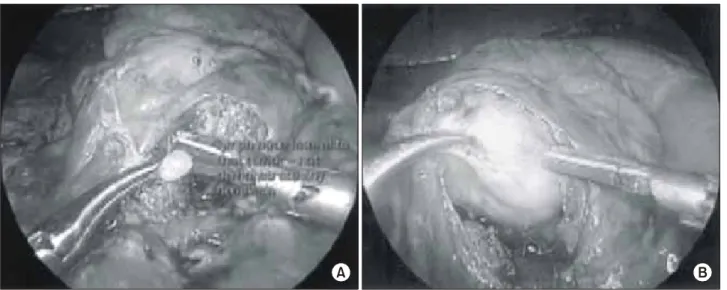 Fig.  4.  (A)  A  1  cm  lymph  node  lateral  to  the  tumor  was  biopsied.  Frozen  section  evaluate  did  not  demonstrate  a  neoplastic  portion