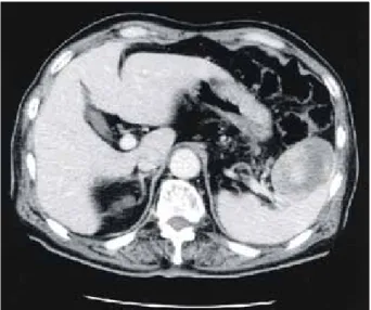 Fig.  2.  Pathologic  specimen  showed  a  well-circumscribed,  ovoid,  bulging-out  soft  mass,  measuring  6.7×5×5  cm  in  the  spleen.