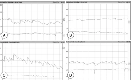 Fig. 2. A follow-up videonystagmogram after barbecue maneuver on next day. Top line indicates horizontal compo- compo-nent and bottom line indicates vertical compocompo-nent on each nystagmogram