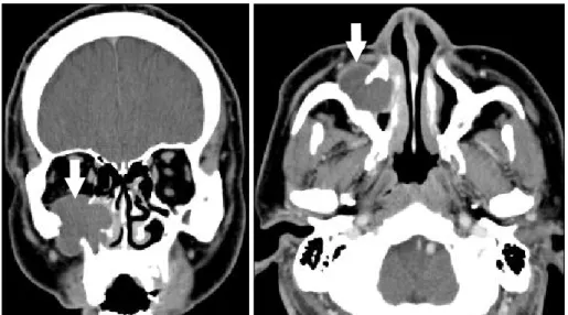 Fig. 2. Preoperative CT images shows the soft density lesion of right maxillary sinus extending into orbital area through bony destruction of infraorbital portion of orbit (white arrow)