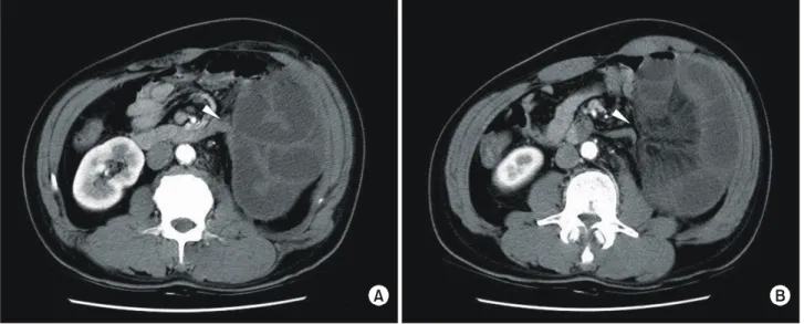 Fig.  1.  Plain  abdominal  film  shows  dilated  loop  of  small  bowel  on  right  lower  abdomen.