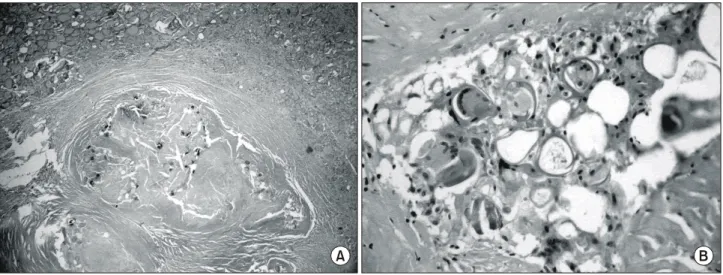 Fig.  2.  USG  shows  1.3×0.8  cm  sized  well-defined  hypoechoic  nodule  containing  calcifications  at  upper  portion  of  right  thyroid  gland.