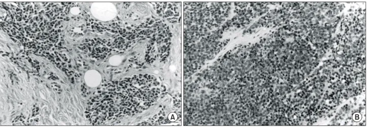 Fig.  2.  The  intraabdominal  mass  was  a  large  lobulated,  gray-white  solid  mass  with  necrosis.