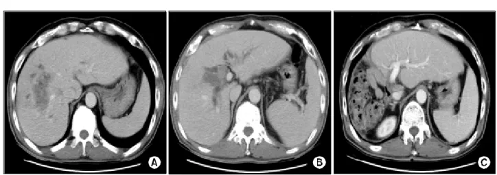 Fig.  2.  Gross  finding  of  Rt.  hepatocellular  carcinoma  in  the  section  of  liver