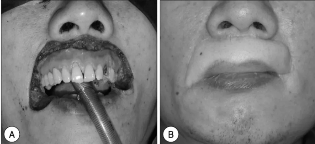 Fig. 2. Wide resection and reconstruction. Wide resection of upper lip lesion was performed including 1 cm safe ma- ma-rgin of the mass (A)