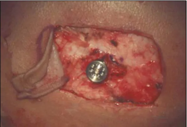 Fig. 8. Inserted fixture with abutment before reposition- reposition-ing of the skin flap