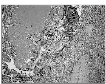 Fig.  3.  Pathologic  finding  of  the  specimen  shows  characteristic  abnormal  trophoblastic  hyperplasia  and  anaplasia,  absence  of  chorionic  villi,  and  hemorrhage  (H&amp;E  stain,  ×100).