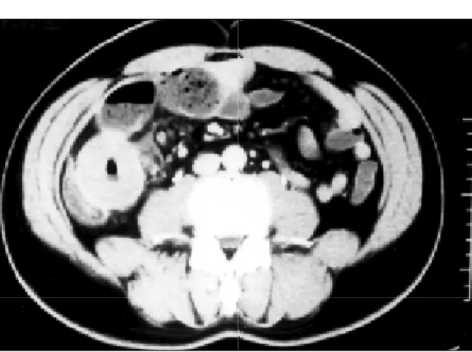 Fig.  2.  Gross  finding  of  the  resected  specimen.  Resected  specimen  shows  a  12×7×2.5  cm  sized  solid  mass  with  hemorrhage.