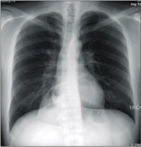 Fig.  1.  Chest  X-ray.  Air-filled  bowel  shadow  was  seen  in  thoracic  cavity.