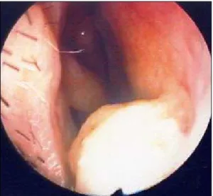 Fig. 2. Round shape soft tissue mass is seen in Rt. nasal septum and  ho-mogeneous well enhancement is seen