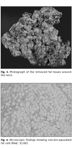 Fig. 3. Photograph of the removed fat tissues around the neck.   