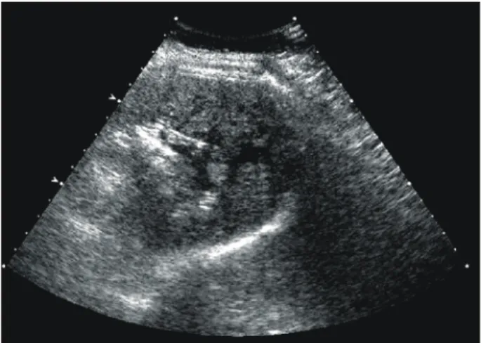 Fig.  1.  Ultrasonography  showed  sligthly  enlarged  spleen  with  diffuse  inhomogeneous  echogenecity  having  a  few  small  cystic  and  increased  echoes.