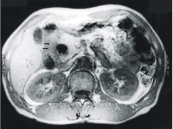 Fig.  4.  Surgical  specimen  shows  a  submucosal  solid  mass  (arrows)  at  the  second  portion  of  the  duodenum,  with  whitish  color  in  cross-section.