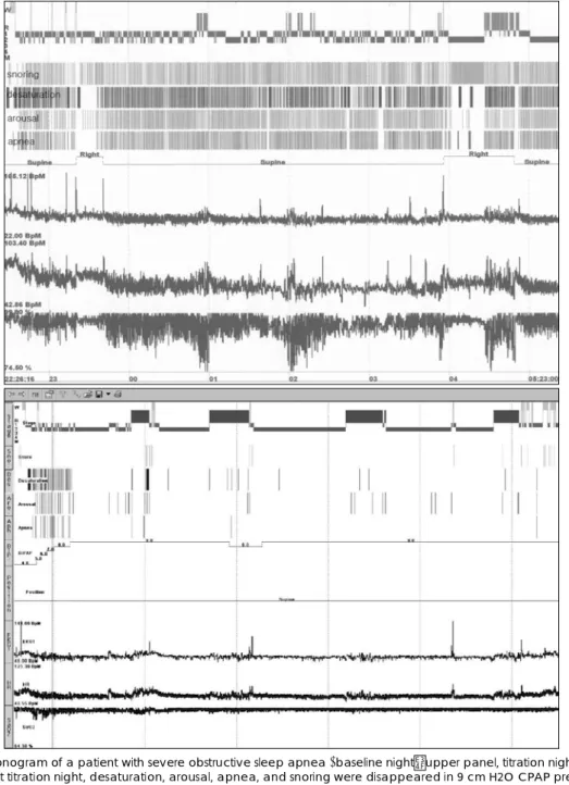 Fig. 2. Hypnogram of a patient with severe obstructive sleep apnea (baseline night：upper panel, titration night：lower panel)
