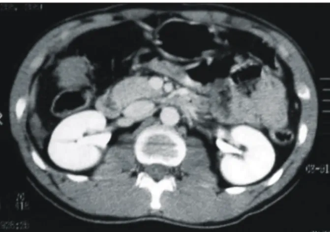 Fig.  1.  Abdominal  CT  shows  2.5  cm  sized  hematoma  in  the  front  of  ascending  colon.