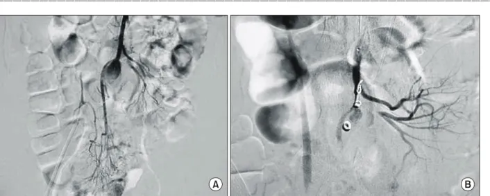 Fig.  3.  3  cm  sized  pseudoaneurysm  was  resected  with  adjacent  ileal  segment.