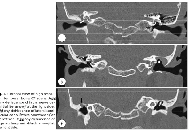 Fig. 1. Coronal view of high resolu- resolu-tion temporal bone CT scans. A：