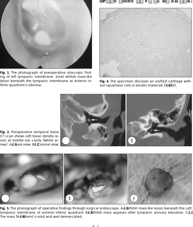 Fig. 2. Preoperative temporal bone CT scan shows soft tissue density  le-sion at middle ear cavity (white  ar-row)