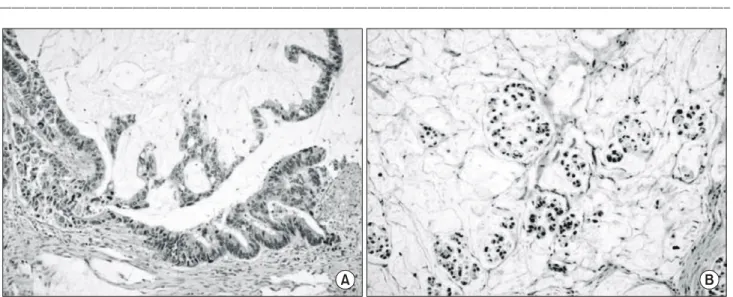 Table  2.  Clinicopathologic  features  of  mucinous  gastric  adenocar- adenocar-cinoma  with  different  histologic  subtypes