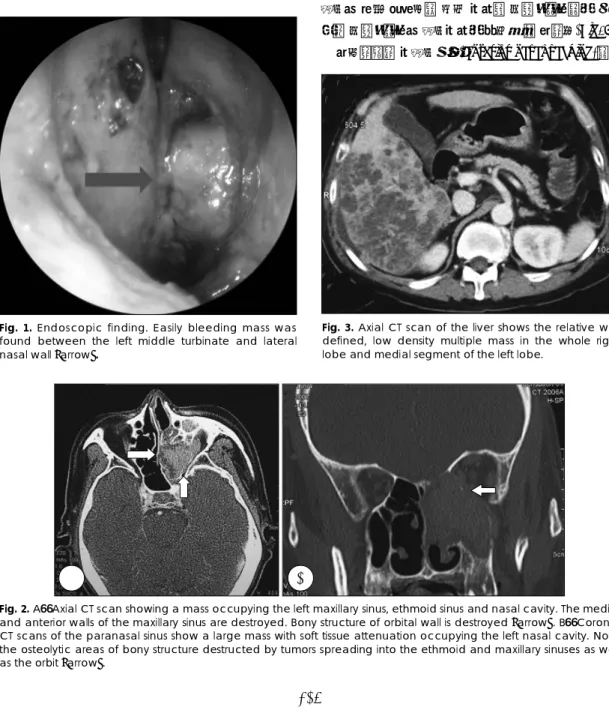 Fig. 1. Endoscopic finding. Easily bleeding mass was found between the left middle turbinate and lateral nasal wall [arrow]