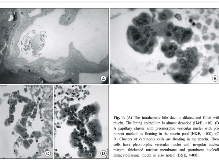 Fig.  5.  Resection  margin  of  the  intrahepatic  duct  shows  marked  denudation  of  lining  epithelium  and  few  strips  of  detached  epithelium  (H&amp;E,  ×40)