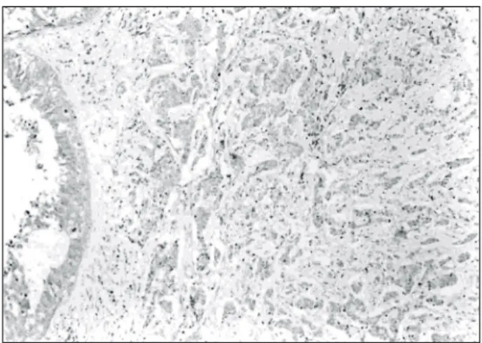 Fig.  1.  Immunohistochemical  staining  for  PTEN  in  the  normal  breast,  PTEN  is  strongly  expressed  in  the  nuclei  and  cytoplasm,  ×100.