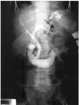 Fig.  3.  Operative  cholangiography  showed  multiple  bile  leakage  of  the  peripheral  bile  duct  in  the  left  lobe  of  the  liver  (arrow)