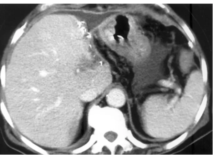 Fig.  5.  Abdominal  Computed  tomography  (CT)  obtained  during  postoperative  period  CT  on  the  7th  postoperative  day  revealed  complete  disappearance  of  the  abscess  cavity