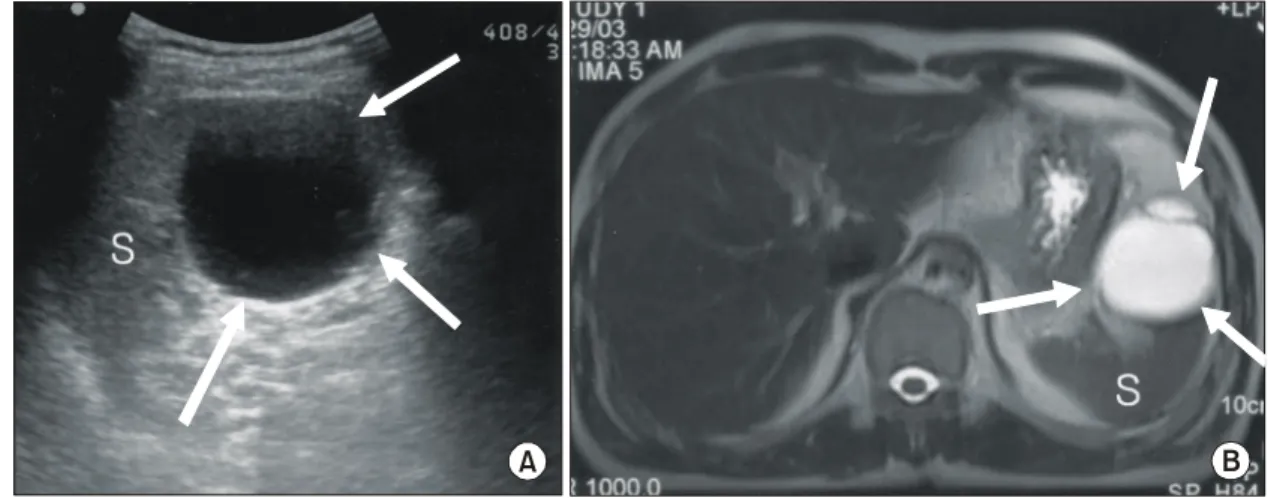 Fig.  2.  The  cyst  was  located  in  the  lower  pole  of  spleen  without  adhesion.
