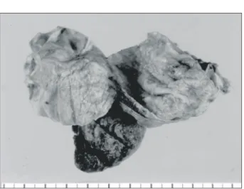 Fig.  4.  Unilocular  cyst  which  was  about  6×5×3  cm-sized  is  located  at  the  edge  of  the  partial  splenectomized  specimen.