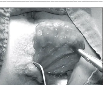 Fig.  2.  Microscopic  finding.  There  are  superficial  mucosal  necrosis  and  patches  of  inflammatory  exudate  (H&amp;E,  ×40).