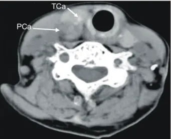 Fig.  2.  Operative  findings  of  case  1.  (A)  The  mass  located  beneath  the  thyroid  lobe  was  dissected  from  thyroid  gland