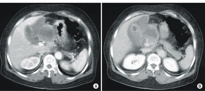Fig.  2.  Upper  gastrointestinal  ra- ra-diological  study,  showing  a  mass  with  ulceration  of  Borrmann  type  II  at  the  antrum  on  the  greater   cur-vature,  suggesting   stom-ach  cancer  (arrow)  (A)