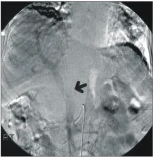 Fig.  3.  Portovenography,  showing  a  mild  luminal  narrowing  of  the  main  portal  vein  (arrow).