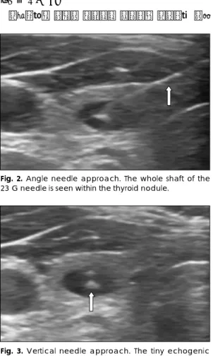 Fig. 3. Vertical needle approach. The tiny echogenic focus within the thyroid nodule is the needle tip during FNA