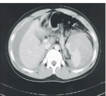 Fig.  2.  The  spleen  was  ruptured  at  the  lower  pole  from  one  of  the  multiple  cyst-like  lesions.