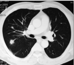 Fig. 2.  Contrast enhanced CT scan of the chest shows  septic emboli in the right lung