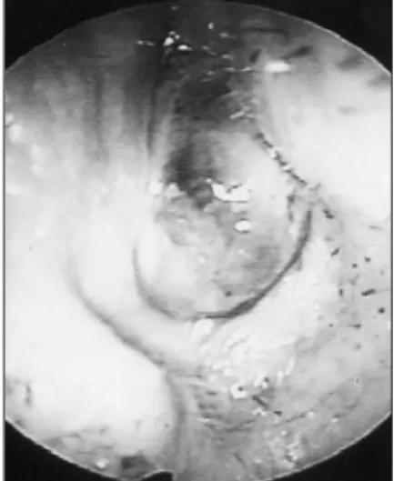 Fig. 2. Axial (A) and coronal (B) CT  images showed the soft tissue mass  obstructing almost entire of the left  nasal cavity